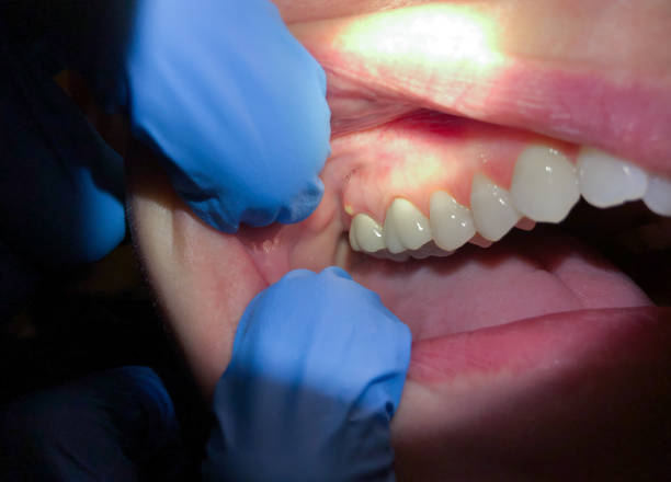 Best Emergency Dental Care for Broken or Chipped Teeth in Ke Providence, LA